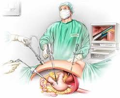 Sleeve Gastrectomy Diagram